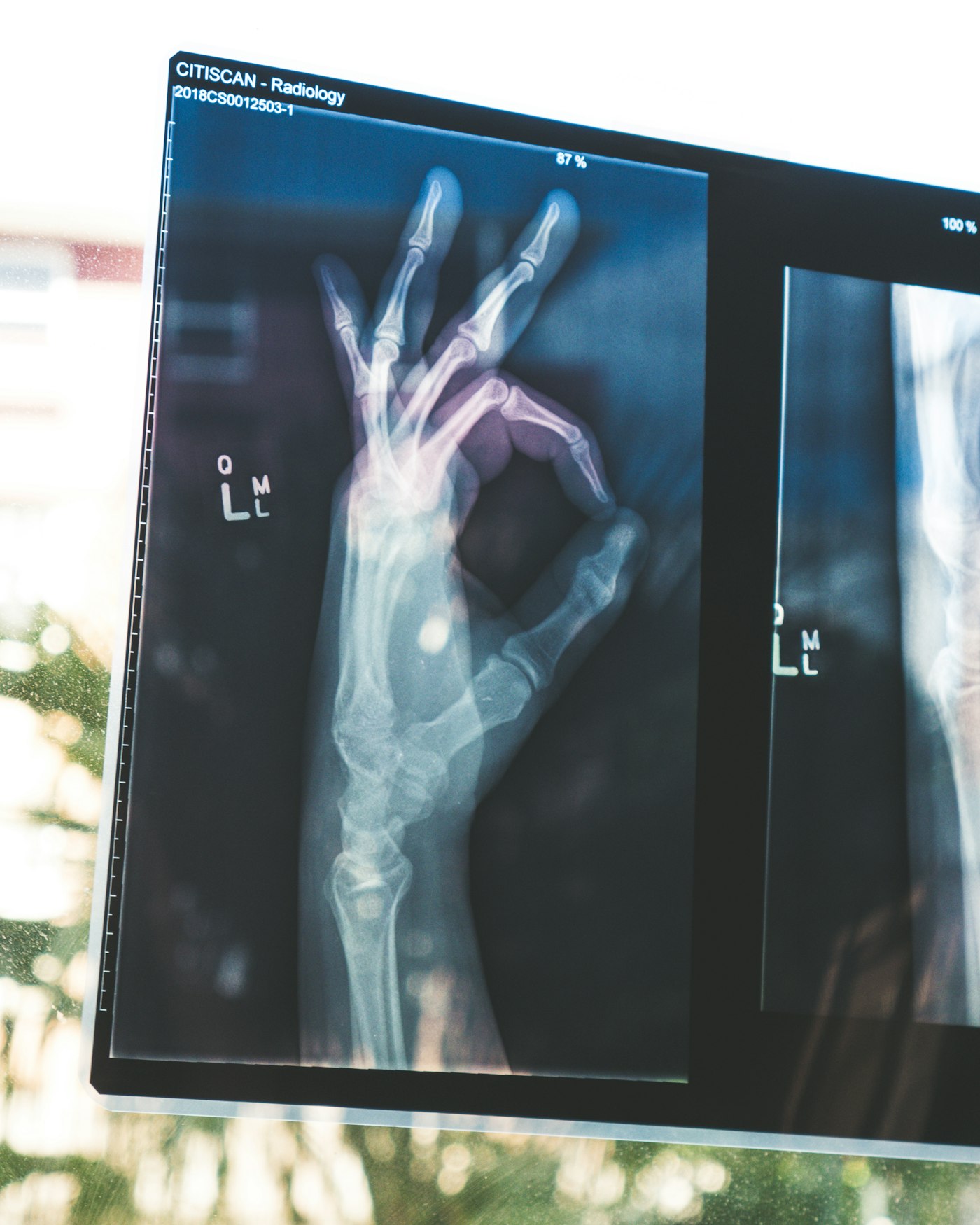 Placeholder photo for malunion and non-union surgery